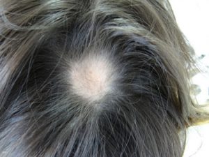 Alopecia areata: causas y tratamientos